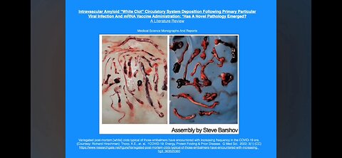 Intravascular Amyloid “White Clot” Circulatory System Deposition Following Primary Particular Viral