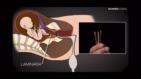 2nd Trimester Abortion