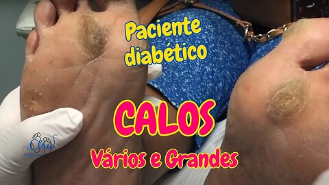 Vários CALOS em pé DIABÉTICO #unhas #pes #dor #podologia #calos #diabetes #pesdiabeticos