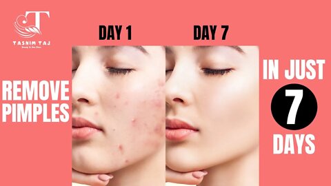 মাত্র ৭ দিনে মুখের ব্রন দূর করার উপায় || How to remove Pimples in just 7 Days || Pimple Treatment