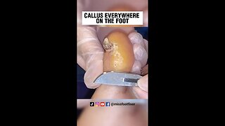 CALLUS EVERYWHERE ON FOOT 2023 [ NEVER ENDING CALLUS SCRAPING ] BY FOOT SPECIALIST MISS FOOT FIXER