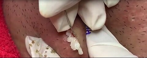 jaw cyst drainage