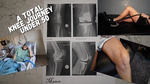 A Total Knee Journey Under 50 Yeas Old - The First 4 Weeks