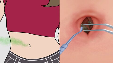 Asmr remove navel worms