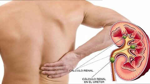 CALCULOS RENALES ARENILLAS COLICO NEFRITICO SOLUCION PARA ACABAR CON LOS CALCULOS