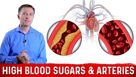 The Effects of High Blood Sugar on Arteries – Dr. Berg on Arteriosclerosis & Atherosclerosis