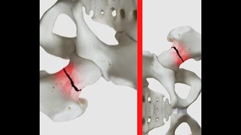 Address your bone loss and Osteoporosis for bone health