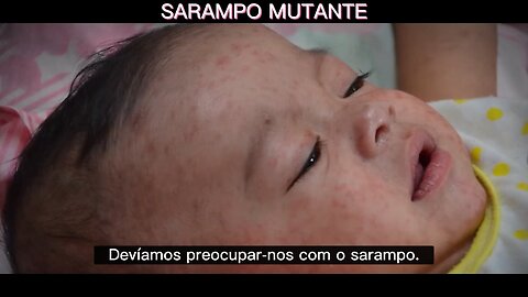 💉⚠️ANDREW WAKEFIELD-DEVEMOS PREOCUPAR-NOS COM O SARAMPO. NÃO É A MESMA DOENÇA QUE ERA ANTES DA VACINAÇÃO💉⚠️