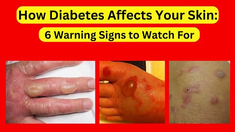 6 Hidden Skin Signs of Diabetes | Diabetes skin signs | Diabetes symptoms | ZeroDiabetes Zone