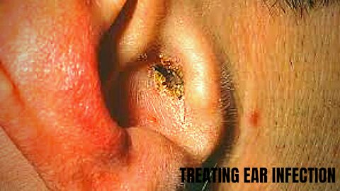 TREATMENT FOR EAR INFECTION