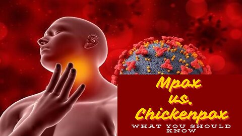 Mpox vs. Chickenpox: Key Differences Explained