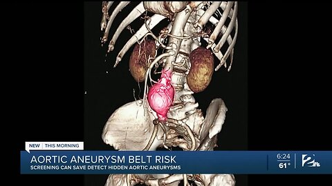 Aortic Aneurysm Belt Risk: Screening Can Save Detect Hidden Aortic Aneurysms