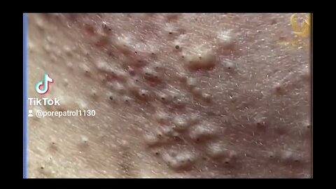 INSANE BLACKHEADS REMOVAL