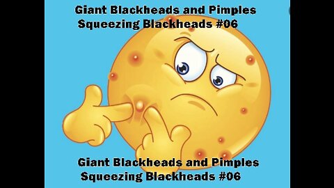 Giant Blackheads and Pimples Squeezing Blackheads #06