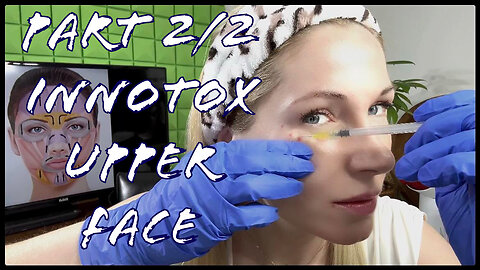 2/2 Upper face Innotox