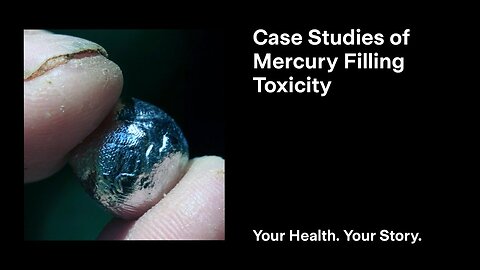 Case Studies of Mercury Filling Toxicity