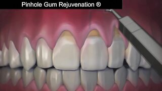 Help for receding gums