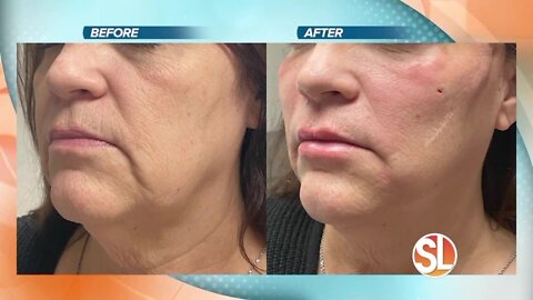 You can get a nonsurgical Mini Facelift at Adair Family Clinic and Medspa