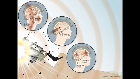 Detecting Post-blast Hearing Loss and Brain Injury