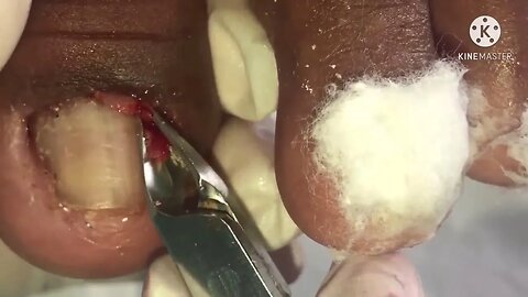 Olha o que acontece quando cutuca com palito, #dor !!! #unhaencravada #podologia #ingrown_toenail