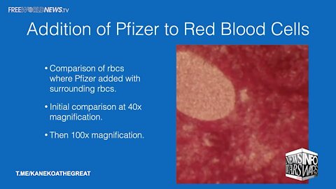 Dr. Richard Fleming: Pfizer Vaccine Causes Blood Clots Under Microscope