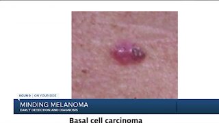 Minding Melanoma Early Diagnosis