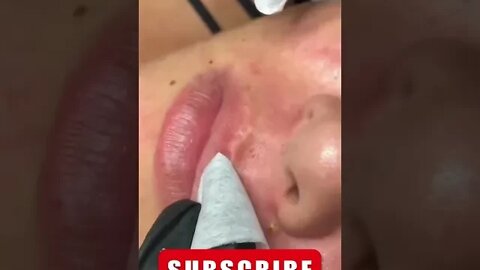 💋 Lips Blackheads & Hidden Acne Removal