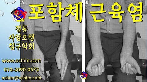 포함체 근육염(봉입체 근염) 치료 후기와 치료 방법 - 사암오행침, 사암침법, 오행침, 정통사암침