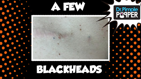 A Few Back Blackheads