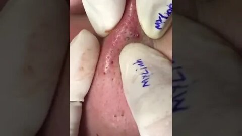 ZOOM IN....PT1 BLACKHEAD EXTRACTION TREATMENT