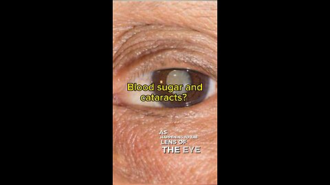 Blood sugars and cataracts?