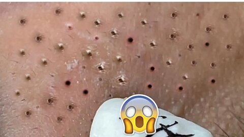 ESPREMENDO CRAVOS GIGANTES Amazing Big blackhead Blackhead Extractions