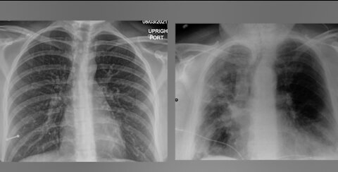 COVID lung X-rays of San Diego patients show 'remarkable' impact of vaccines