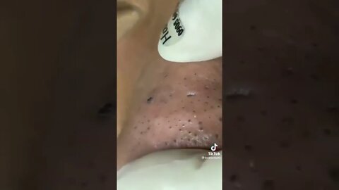 Huge blackhead removal on nose 🫣 just squeeze it already 😅 #blackheadremoval #blackhead #fypage