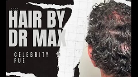 Celebrity FUE: VIP Hair Transplant by Dr. Max - Personalized, Private, Natural Results.