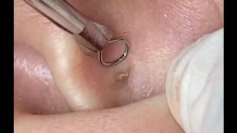 角栓 除去 Blackhead 毛穴 角栓 角栓 除去 角栓除去 Keratin plug removal 角栓抜き tweezers 케라틴 플러그 제거 5