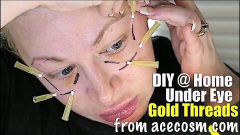 DIY Gold Threads in my Under Eye Circles from Acecosm.com | Code Jessica10 saves you $