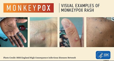 Talking about Mpox 'emergency'