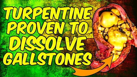 Turpentine is SCIENTIFICALLY Proven To DISSOLVE Gallstones!