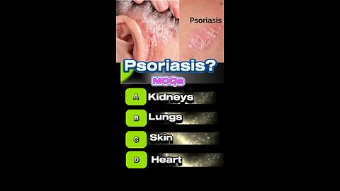 Psoriasis disease mcqs #skindisease #infection🧴💊🏥💉