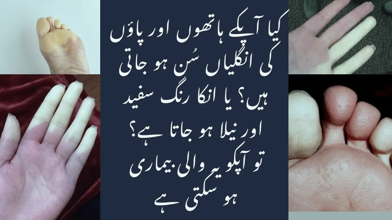 Raynaud s Disease In Urdu Raynaud s Disease In Urdu
