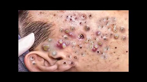 Blackheads and Whiteheads Removal Extraction