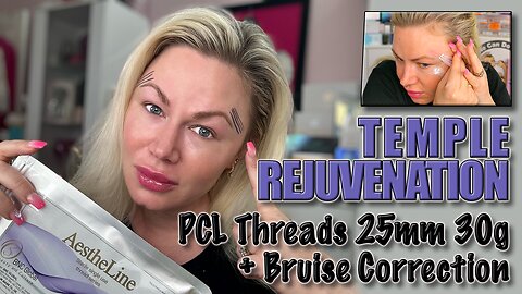 Temple Rejuvination with PCL Screw threads & Bruise correction! AceCosm, Code Jessica10 Saves