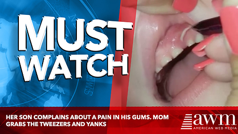 Her Son Complains About A Pain In His Gums. Mom Grabs The Tweezers And Yanks