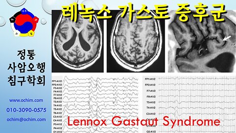 레녹스-가스토 증후군 치료 방법 - 사암침법, 사암오행침, 오행침, 정통사암침