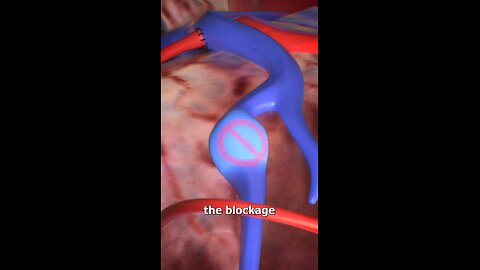 How a Bypass Surgery Operation Works 😲