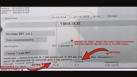 HIV Positive for 25 Years then HIV is GONE - PCR Test Result