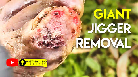 Jigger Removal That Will Keep You Up At Night #1