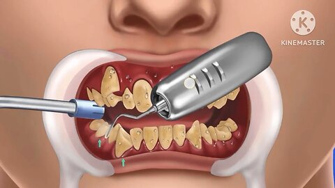 Dental implants, dental implants australia, all on 4 dental implants, dental implants procedure