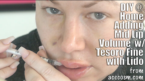 Adding Mid Lip Volume with Tesoro Fine with Lido from acecosm.com | Code Jessica10 Saves you Money!